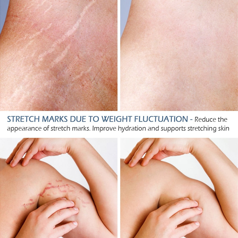 Stretch Marks Skin Care Treatment. Comes in essential oils and Cream For the Removal of stretch marks. Restores and replenishes the skin. - twobusybodies