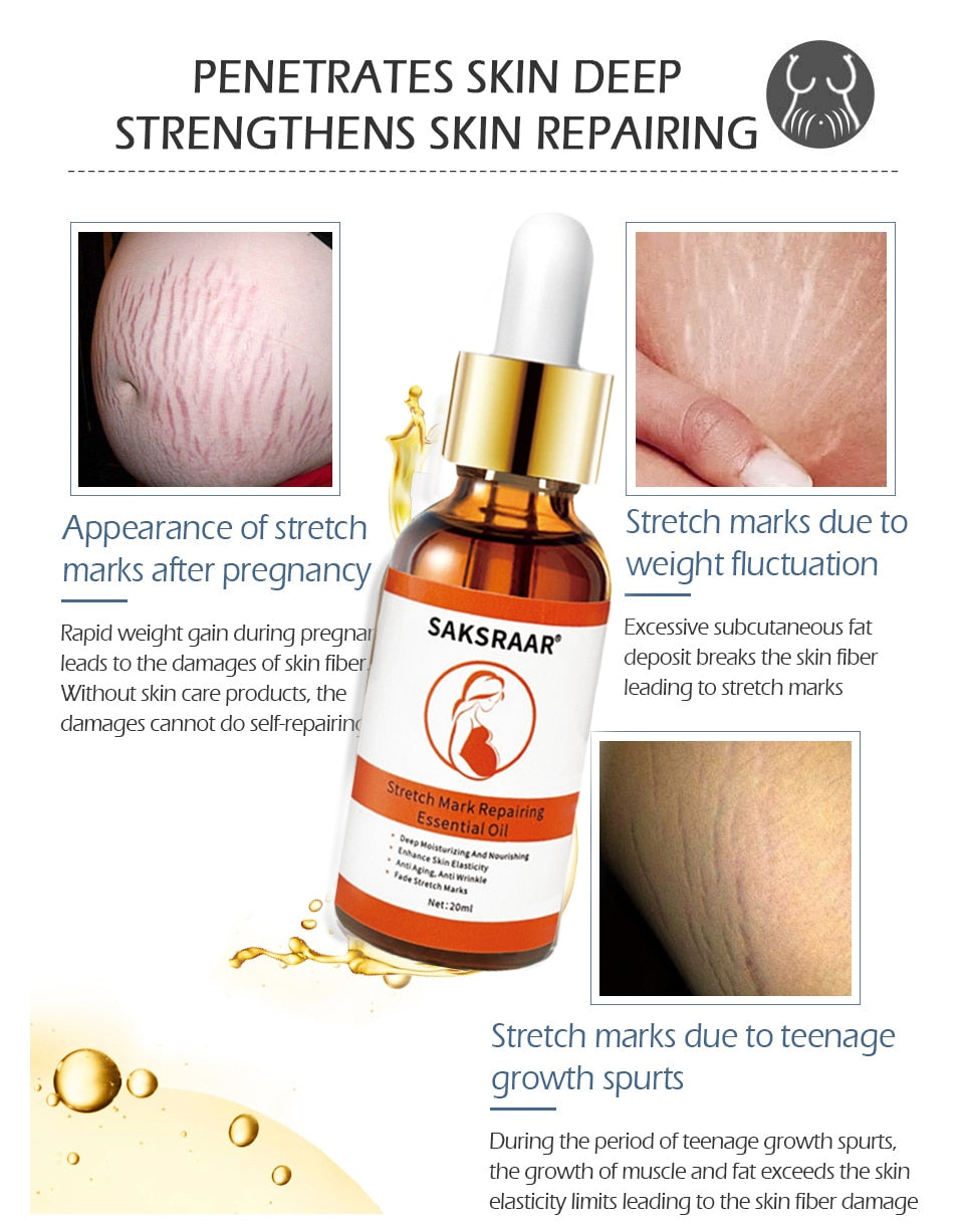 Stretch Marks Skin Care Treatment. Comes in essential oils and Cream For the Removal of stretch marks. Restores and replenishes the skin. - twobusybodies